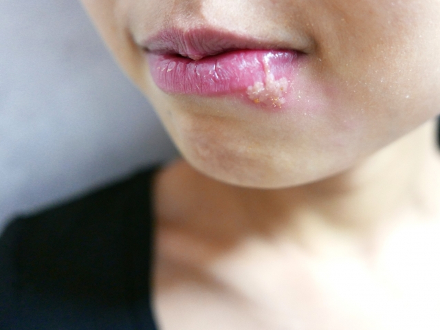 繰り返すヘルペスの再発に。自分で飲める薬「PIT療法」とは？